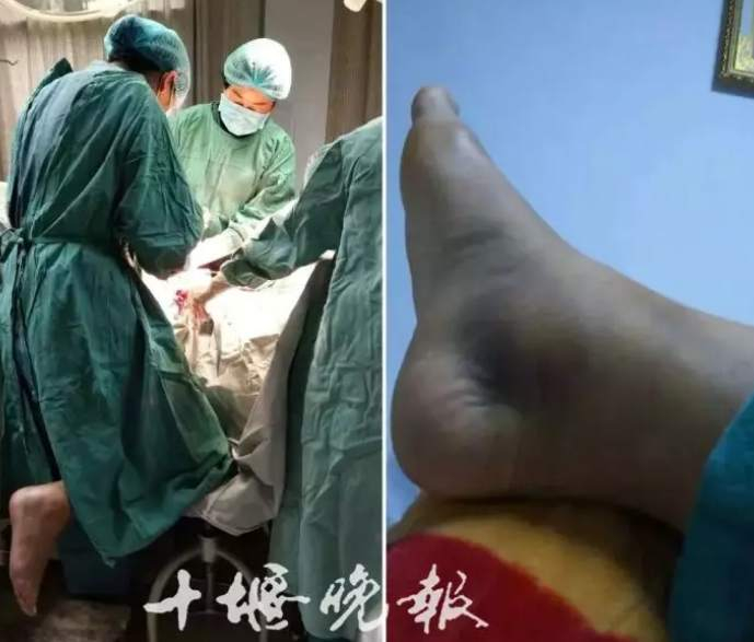 手术结束后，她的右脚肿得更厉害了