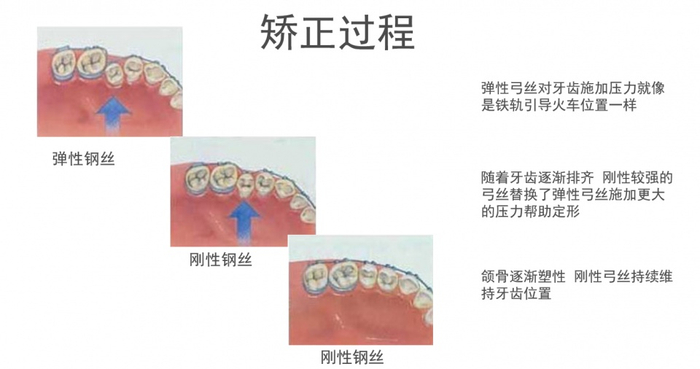 牙齿矫正的详细流程以及矫正器种类的介绍_新浪新闻