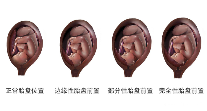 好孕爸日记67:孕早期产检“胎盘前置状态”,不需要过分担心!