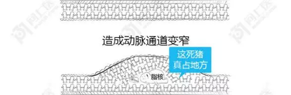 血管硬化后能否逆转?这篇讲清楚了