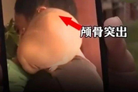 湖南出现“大头娃娃” 患病孩子都喝了这种“特殊奶粉”