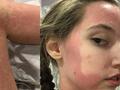英国一女子对所有食物过敏 靠心脏输液维生