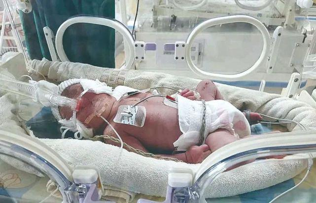 ▲男婴正在新生儿科接受治疗 通讯员供图