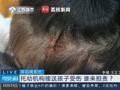 托幼机构帮忙接送孩子致摔伤 律师:机构应尽管护义务,需赔偿
