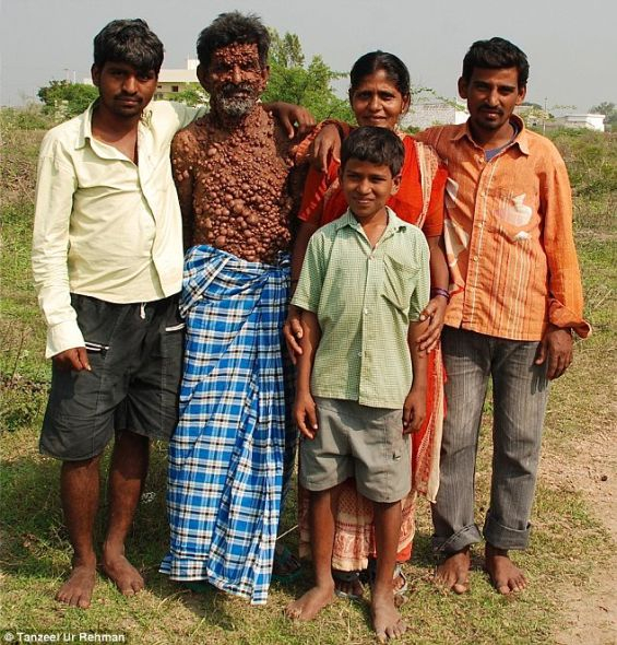 家庭生活：乌马尔和他的妻子以及三个孩子。他们现在很担心乌马尔的病会遗传给他们的孩子们