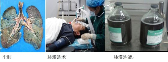 目前有效方法之一是大容量肺灌洗，但肺灌洗并不能延缓或控制纤维化进展。