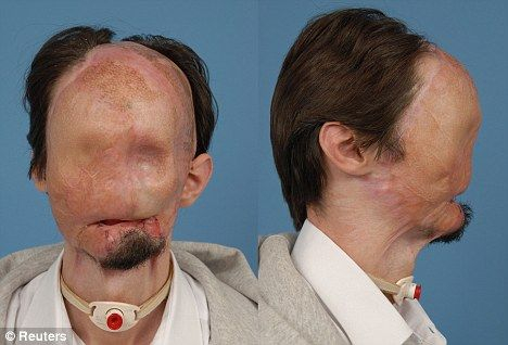 两年前建筑工人达拉斯·韦恩斯在高压线事故中面部严重烧伤