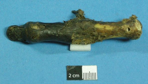 雪人手指，这张照片在伦敦皇家外科学院展览