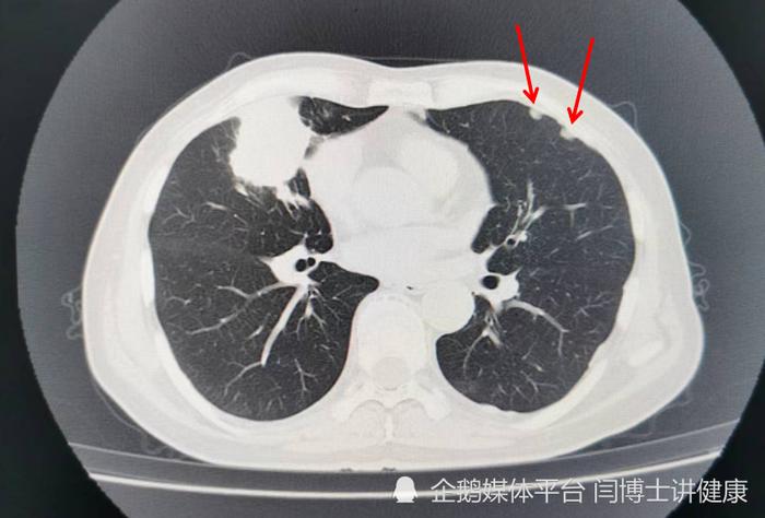 该病人胸部CT检查示左侧胸膜2个结节（箭头所指为胸膜结节）