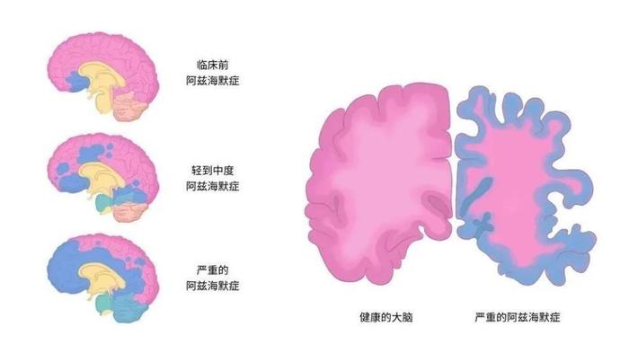 阿尔茨海默病患者大脑状态 来源：澎湃新闻