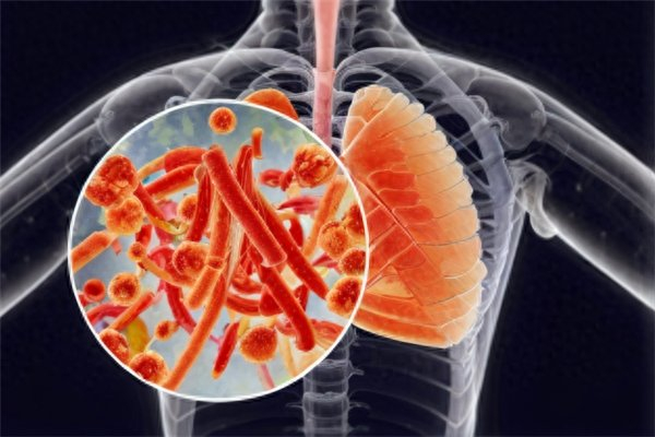 支原体肺炎来袭多地出现感染高峰我们如何应对