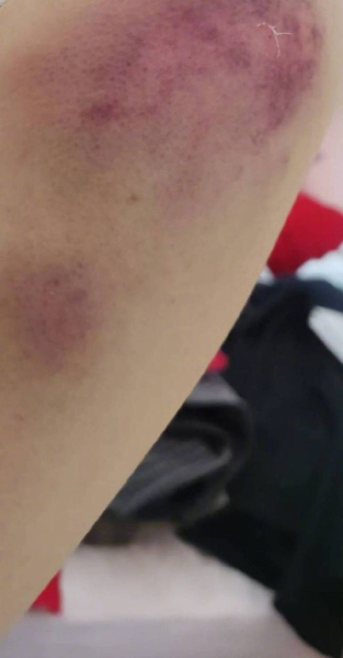 李女士被家暴后受伤。受访者供图&nbsp;