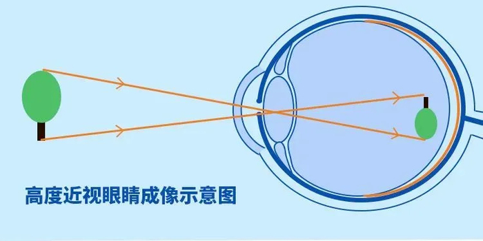 当高度近视遇上白内障,宁波爱尔飞秒白内障技术护航清晰视界!