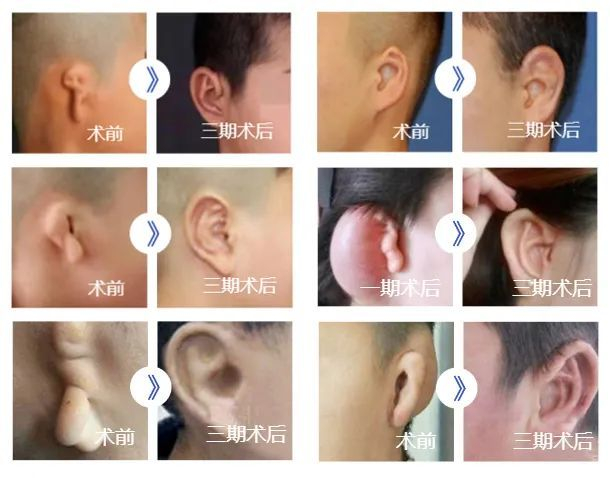 小耳畸形手术少年长大了,如今实现更多孩子双耳梦|手术|耳朵|外耳