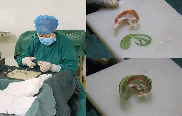 小耳畸形手术少年长大了,如今实现更多孩子双耳梦|手术|耳朵|外耳