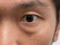 眼袋大也是脾胃虚的表现，3个典型症状判断