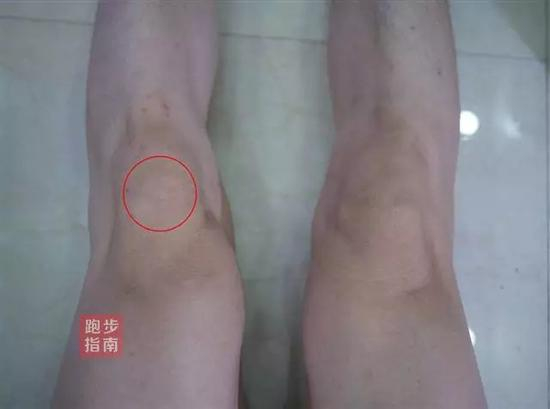 跑步膝大部分的原因有：