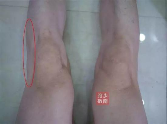 ITBS产生的原因：髂胫束收到挤压，髂胫束和股骨头的上端产生摩擦。或者阔筋膜张肌和髂胫束过于紧张，或者肌肉力量不均衡。