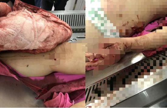  王萱遗体有多处伤痕