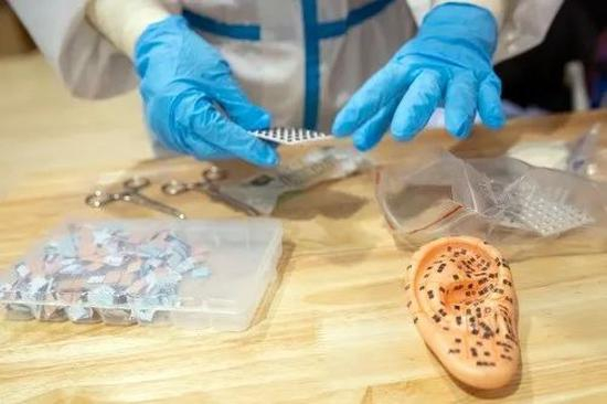 ▲2月25日，在江夏方舱医院，湖南中医药大学第一附属医院护士长涂丽准备为新冠肺炎患者实施中医耳穴压豆治疗。新华社记者沈伯韩摄