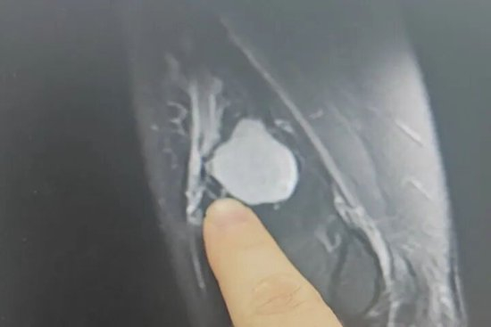 患者的肘部包块在磁共振下的影像。