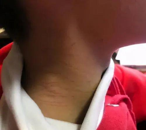  被劫持孩子脖子上的划痕