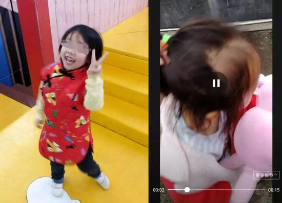 图左：毕某女儿服用无限极产品前，头发浓密且乌黑油亮；图右：毕某女儿服用无限极产品四个月后，头发枯黄，前额头发稀疏。 毕某供图