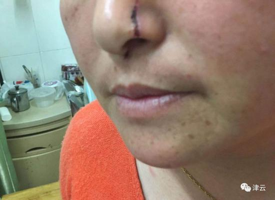  贡欣鼻子被陈杰用刀划伤&nbsp; &nbsp; &nbsp;