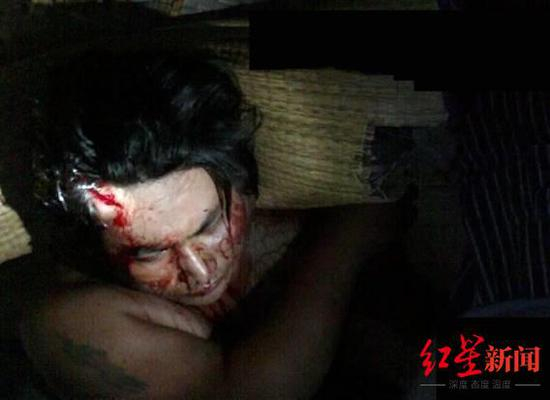 ▲案发后，去诊所包扎伤口的张海宾