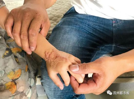 女孩手上的伤疤。（近日拍摄）