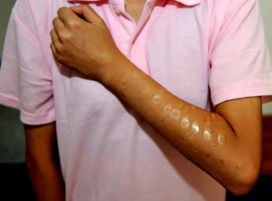  在天津市女子强制隔离戒毒所，一名戒毒人员展示胳膊上用烟头烫过针孔的伤疤。新华社发（连漪 摄）