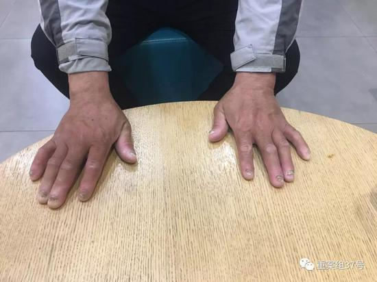 ▲刘忠林展示受伤的手指。 &nbsp; &nbsp;新京报记者&nbsp;袁静伟 摄