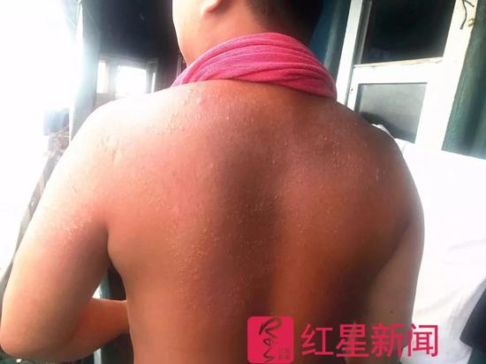 ▲船上，一位船员被晒伤的背 &nbsp;受访者供图