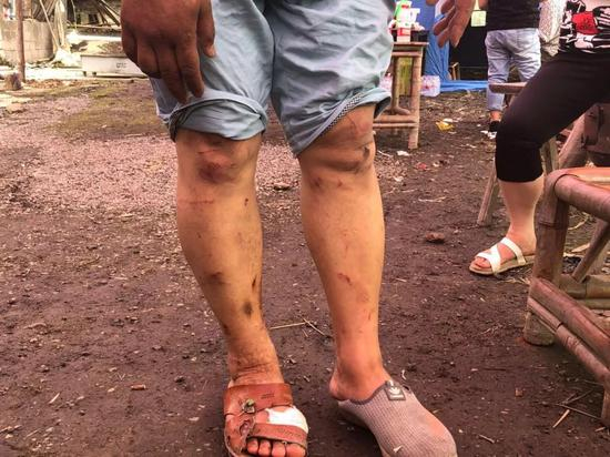 　▲地震后，赵宇的丈夫腿上全是刮痕。新京报记者 解蕾 摄