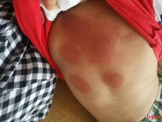 7月12日，吴萌的孩子贴三伏贴后，背部发红