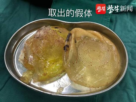 从孙女士胸部取出的假体已破裂。