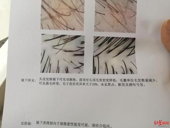  小王为头发困扰