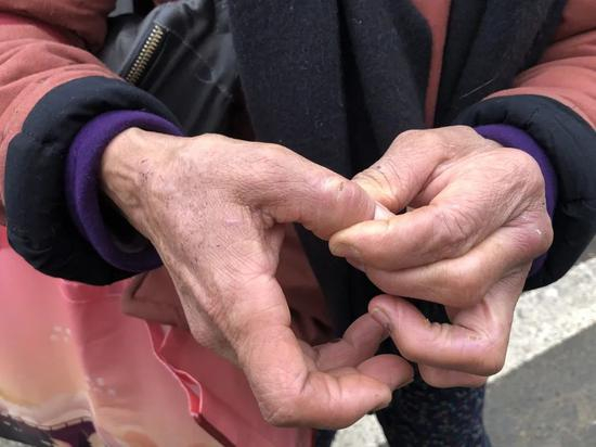 ▲文军红的手上布满狗咬的伤痕和干裂的伤口。新京报记者&nbsp;王翀鹏程 摄&nbsp;
