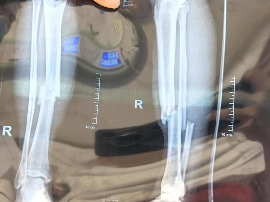 ▲小杨医学影像显示为胫腓骨骨折 受访者供图