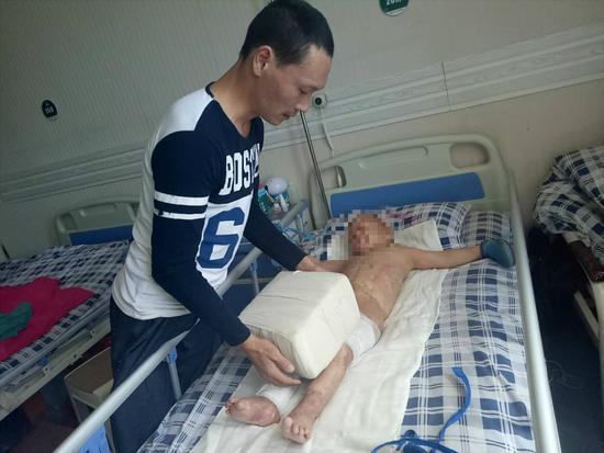 图为余静永小心地将用布包好的砖块压在儿子腿上。受访者供图