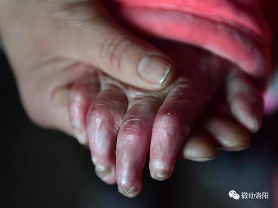 媛媛右手的四个指头，没有指尖也打不开了。