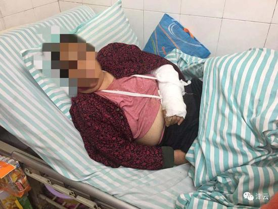  贡欣的母亲被陈杰打骨折&nbsp; &nbsp;