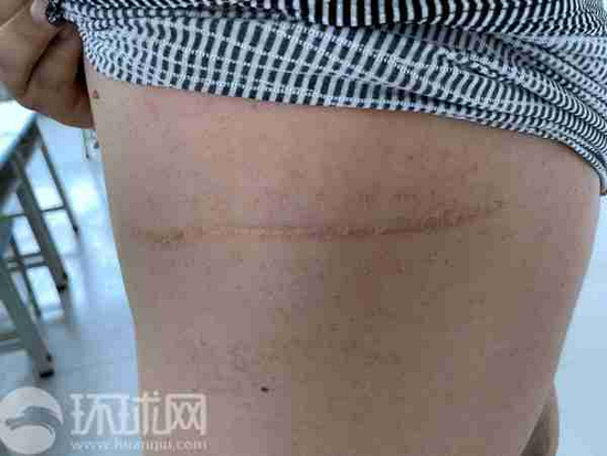 努尔麦麦提中弹后留下的伤痕。摄影范凌志