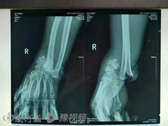 　三轮车驾驶员X光片