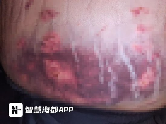  阿宝腹部大面积淤青