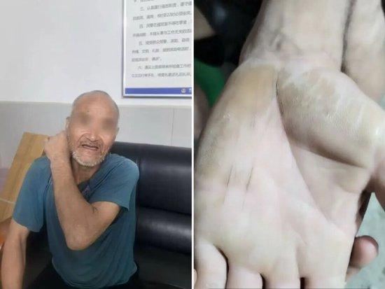 寇聚合刚被找到的时候和他手上的老茧