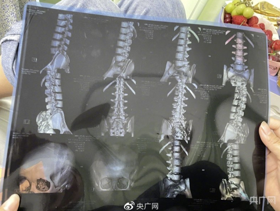 小朱拍的CT片（央广网记者 蔡文娟 摄）