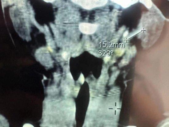 b超孕囊形状图片图片