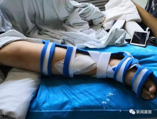 嫣楚的右腿胫骨骨折