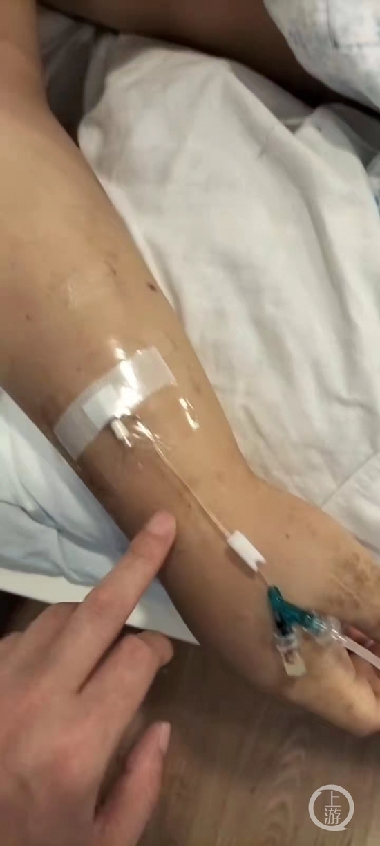 医生指出李亚缘纶手臂上有多处针眼&nbsp; &nbsp; 图片来源：中柬义工队提供视频截屏